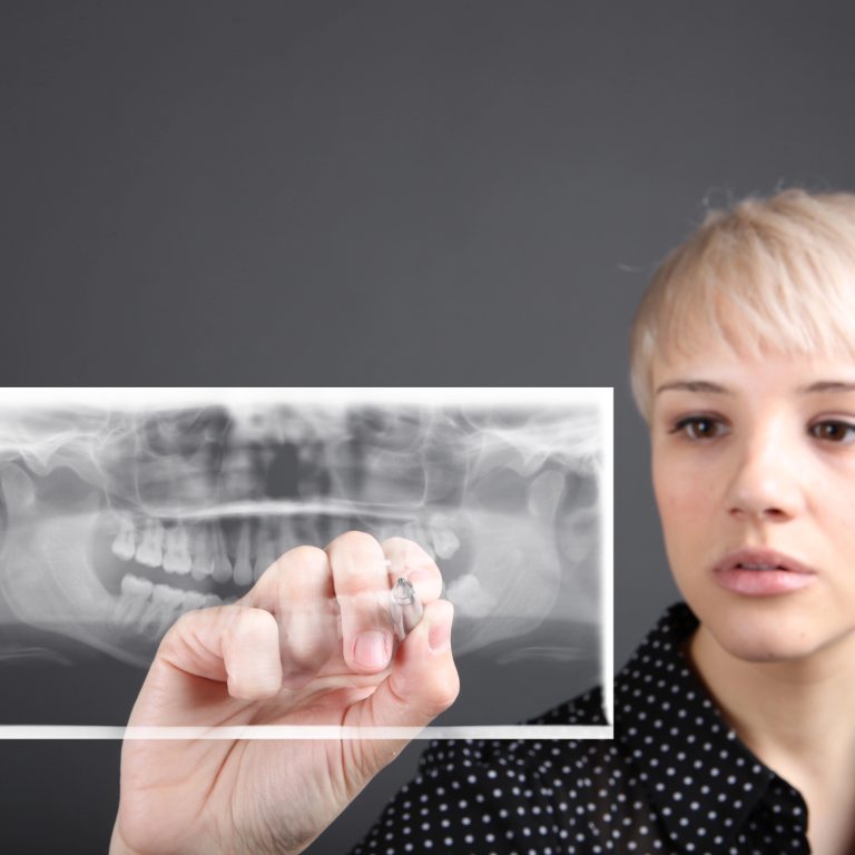 מה ההבדל בין הרמת סינוס והשתלת עצם