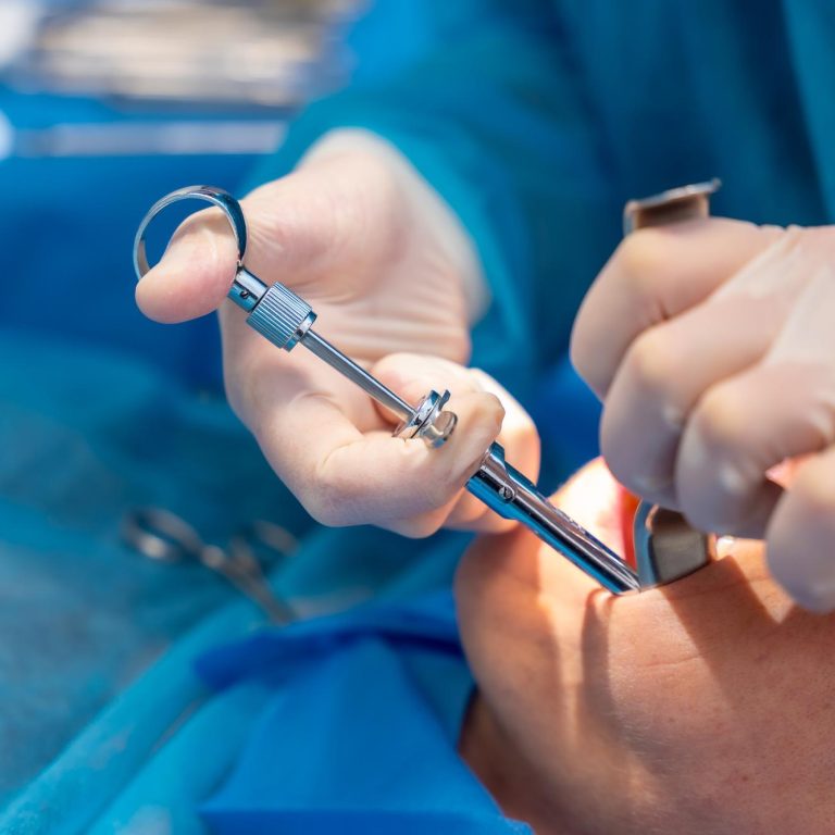 עקירת שן כירורגית